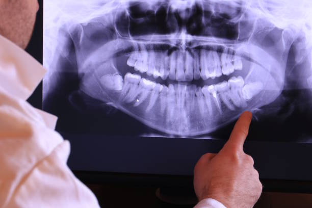 Best Emergency Dental Extractions in Newton, NC